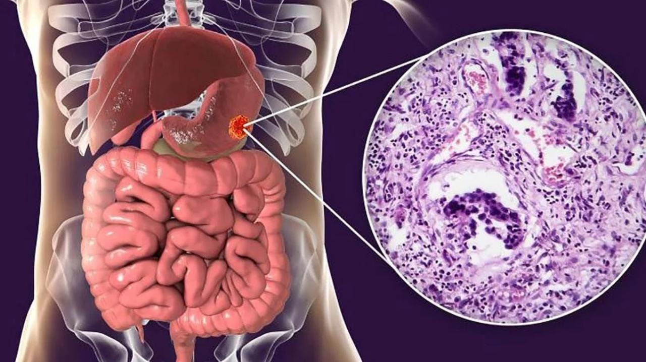 Investigadora UFRO por innovador tratamiento para el cáncer gástrico: “Estudiamos el matico para ver si tenía propiedades antitumorales o que revirtieran la resistencia a quimioterapia”