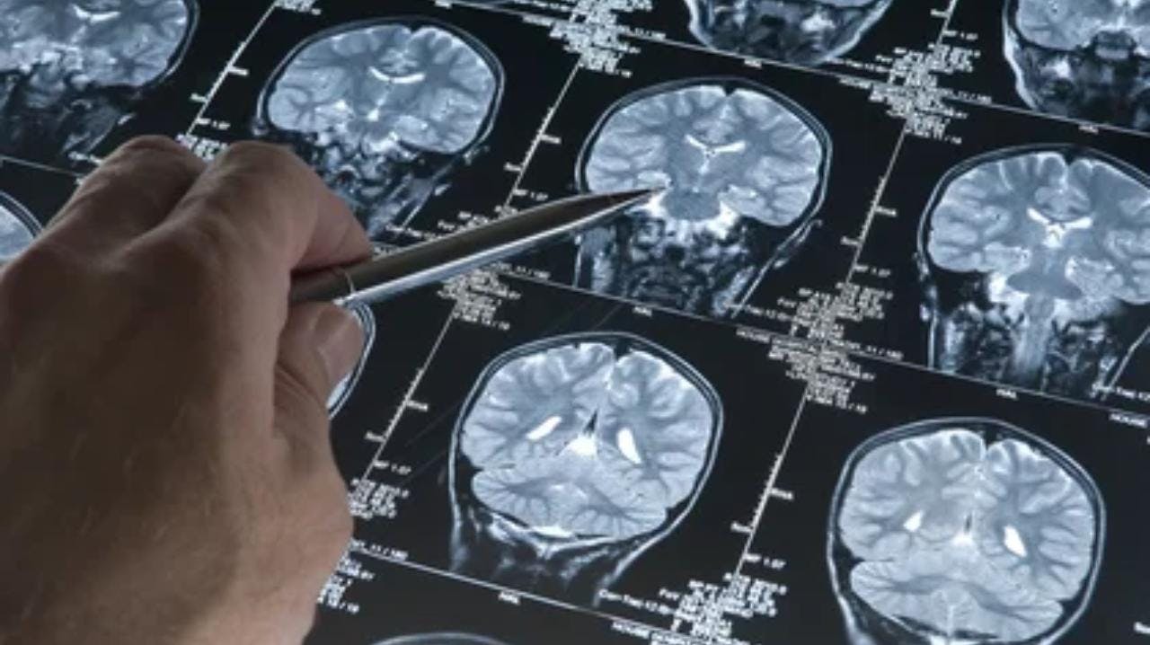 Investigador U. de Chile por hallazgo potencialmente beneficioso para la lucha contra el alzhéimer: “Más adelante queremos evaluarlo en pacientes sanos para ver si hay algún efecto secundario”