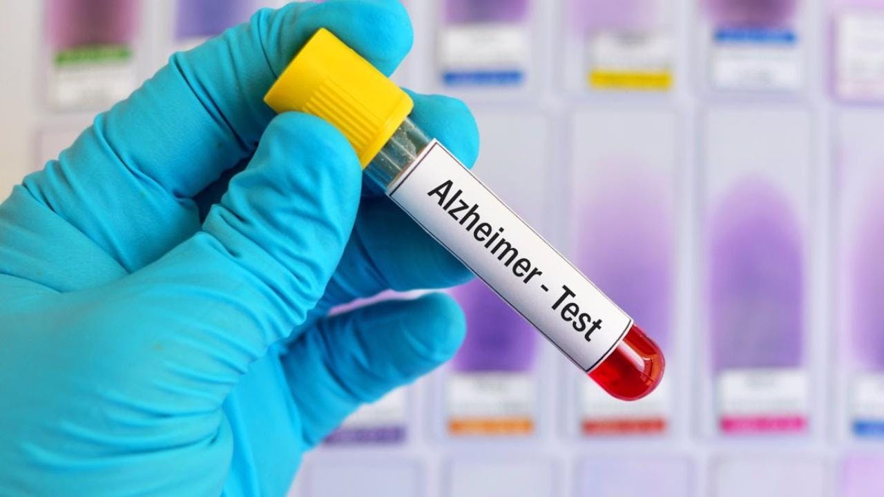 Predecir el Alzheimer con un exámen de sangre