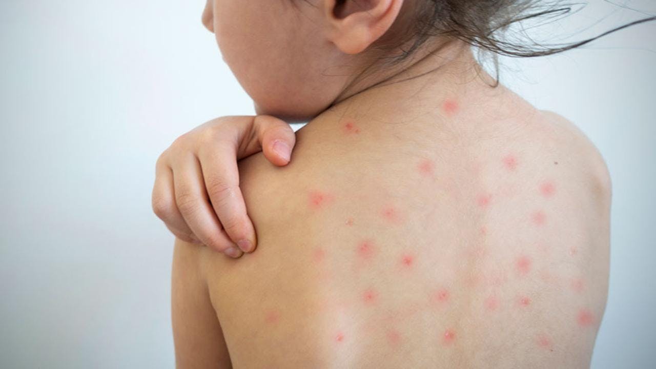 Por brote de sarampión en EE.UU, sugieren vacunarse con dosis de refuerzo a los nacidos entre 1971 y 1981: Aquí por qué