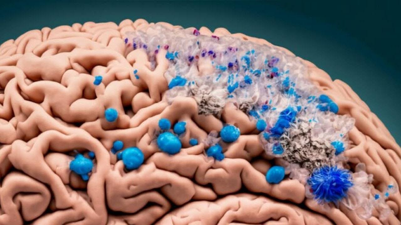 Microplásticos en el cerebro aumentan trastornos de salud mental