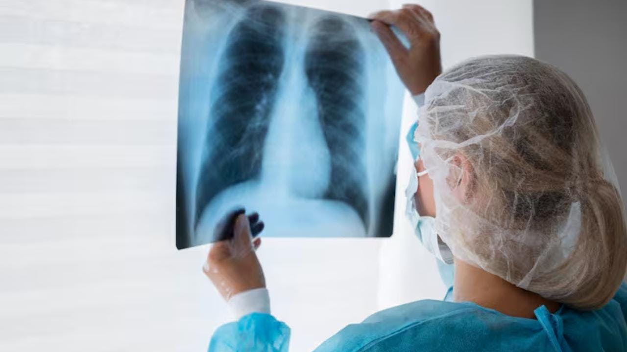 Aumentan los casos de tuberculosis en el Biobío: qué es, cómo se transmite y cómo prevenirla