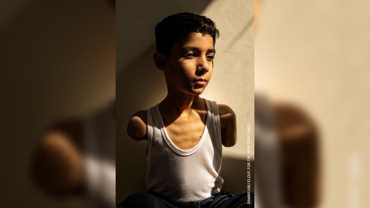 Foto de niño palestino amputado, gana el World Press Photo
