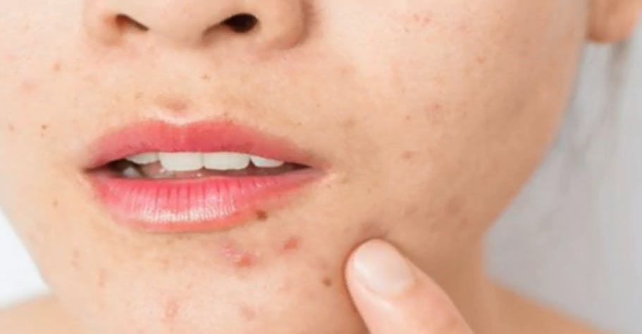 ¿Granitos en la cara por la mascarilla? Los problemas en la piel que ha dejado la pandemia