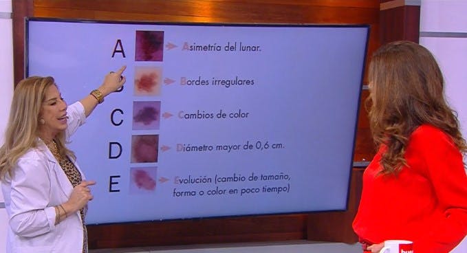 Atención con el A,B,C,D y E de los lunares