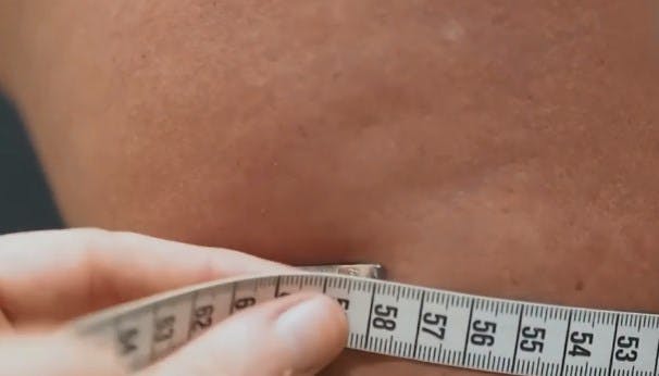 Celulitis ¿Cómo combatirla y evitar que sea una enfermedad? 