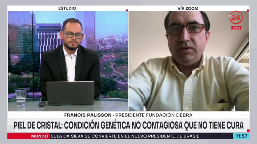 Día Internacional de la Piel de Cristal: En Chile tenemos un número de casos bien elevado