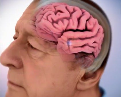Alzheimer: ¿Puede desarrollarse a temprana edad?