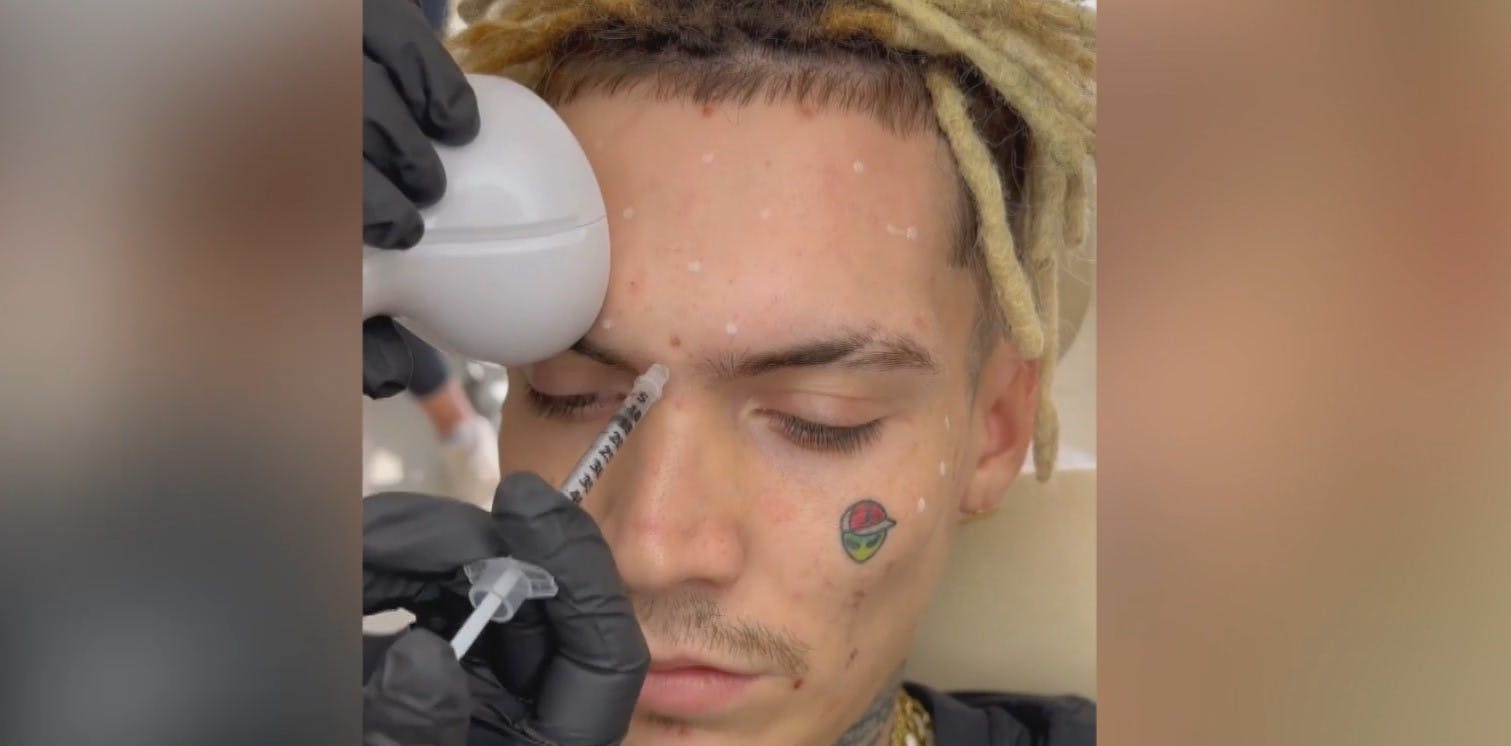 ¿En qué consiste? Marcianeke se hizo una armonización facial masculina