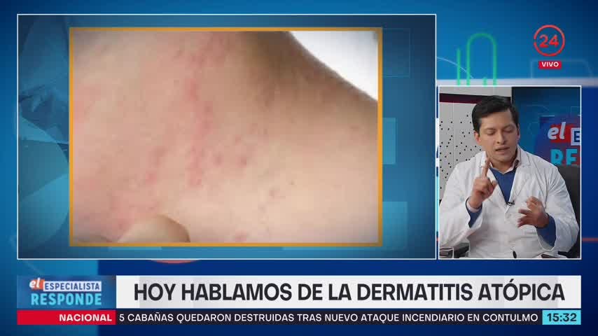 El Especialista responde: Dermatitis atópica