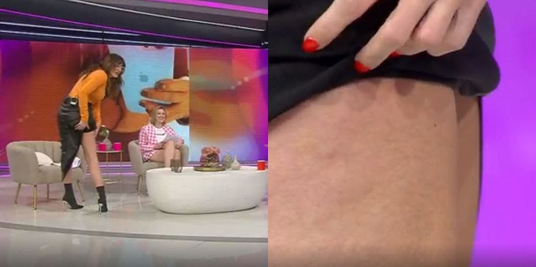 Esto que tengo acá es celulitis