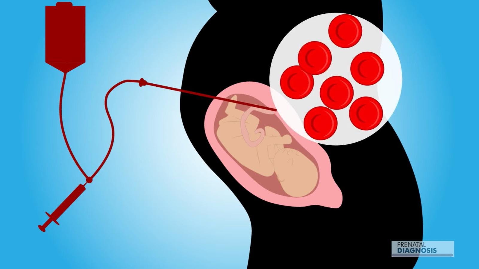 Hospital regional realiza primera transfusión intrauterina 