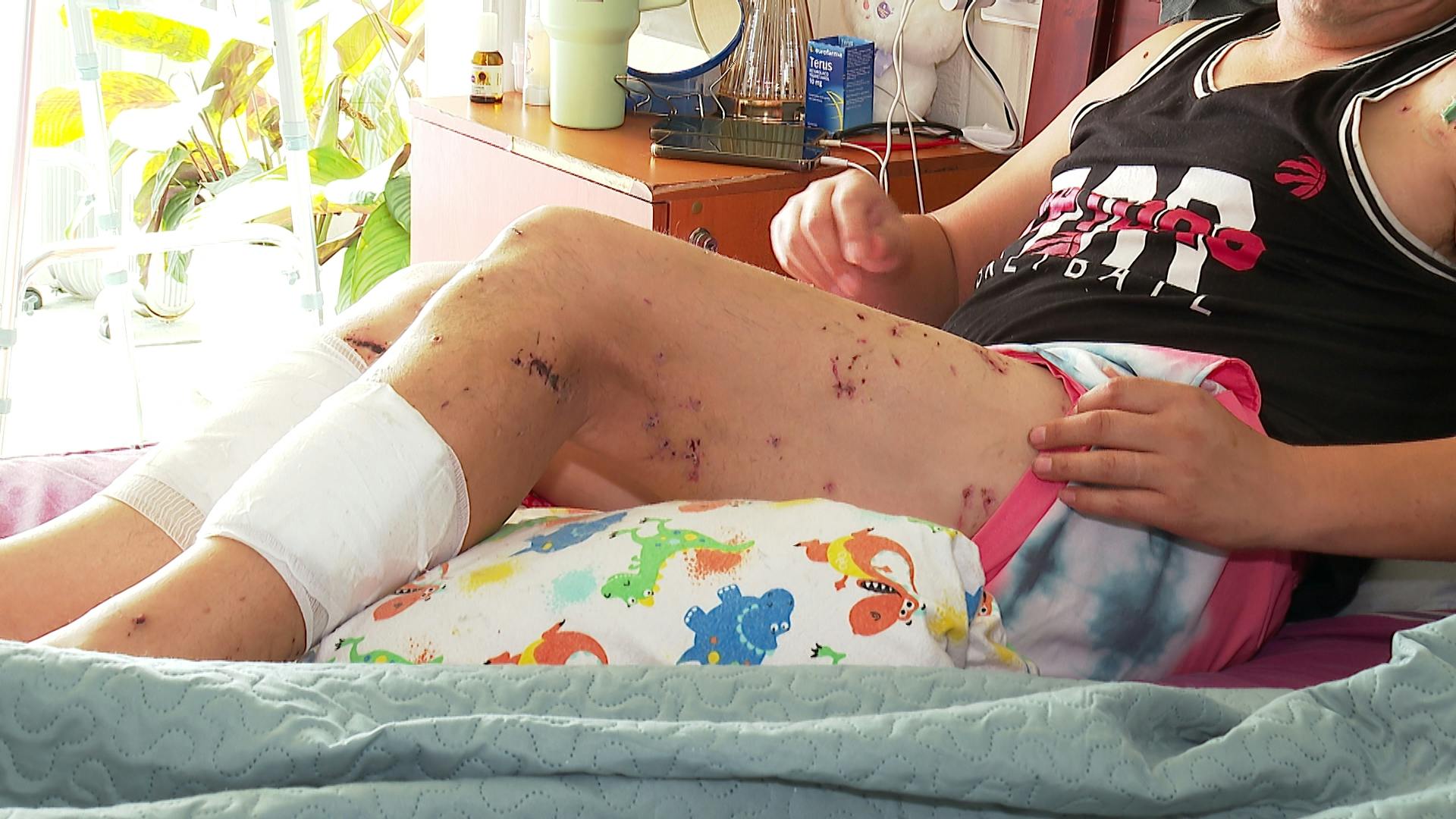 Más de 80 mordeduras en todo su cuerpo: hombre de 43 años fue atacado por jauría de perros en Hualqui