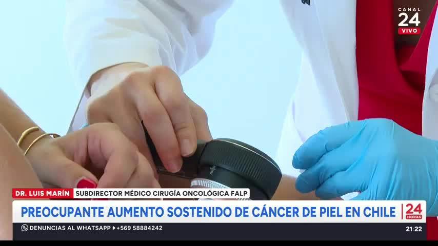Preocupación por aumento sostenido de cáncer de piel en Chile
