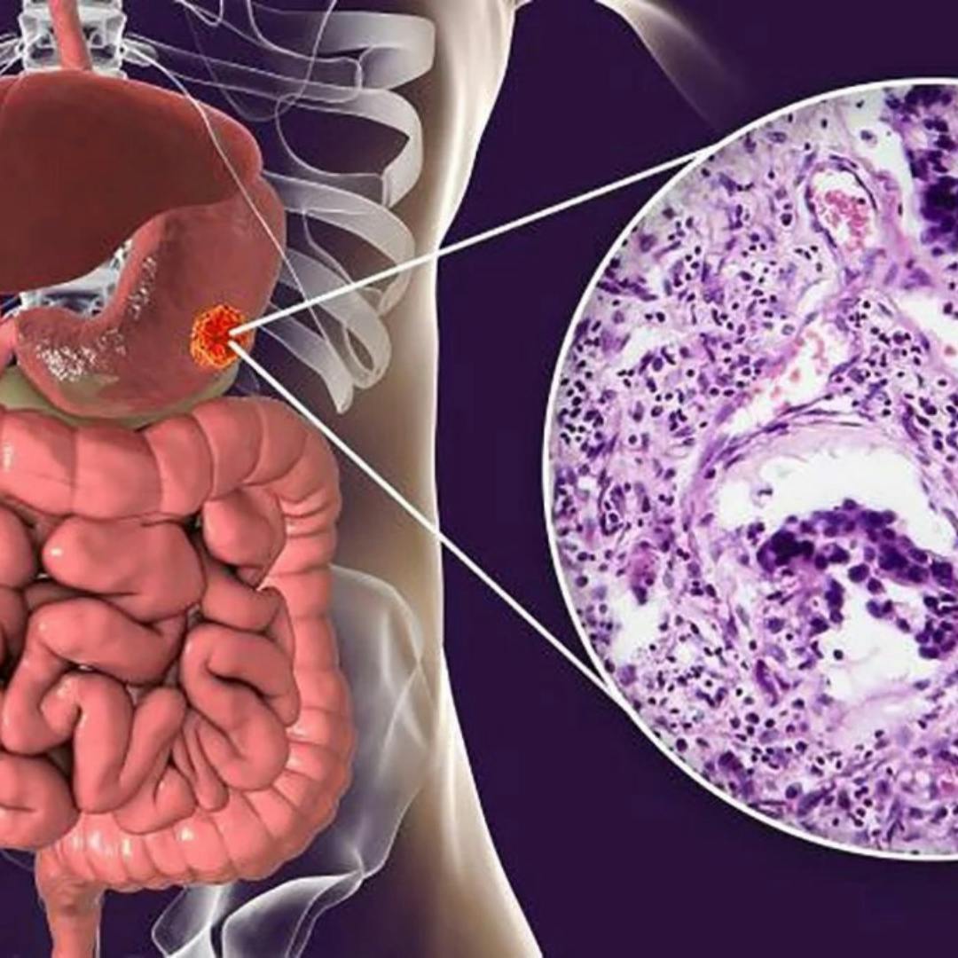 Investigadora UFRO por innovador tratamiento para el cáncer gástrico quimiorresistente: “Incorporamos el matico en el estudio, para ver si tenía propiedades antitumorales o que revirtieran el genotipo de resistencia a quimioterapia” 