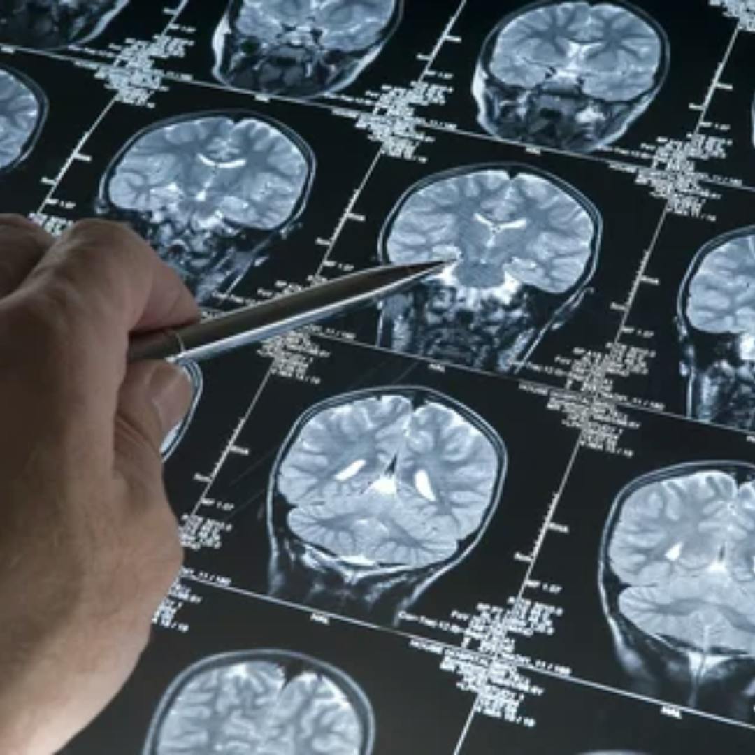 Investigador U. de Chile por hallazgo potencialmente beneficioso para la lucha contra el alzhéimer: “Más adelante queremos evaluarlo en pacientes sanos para ver si hay algún efecto secundario”