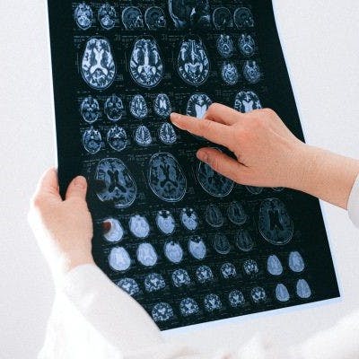 Neurólogo UC CHRISTUS por accidentes cerebrovasculares: “Es la mayor emergencia médica después del paro cardiaco