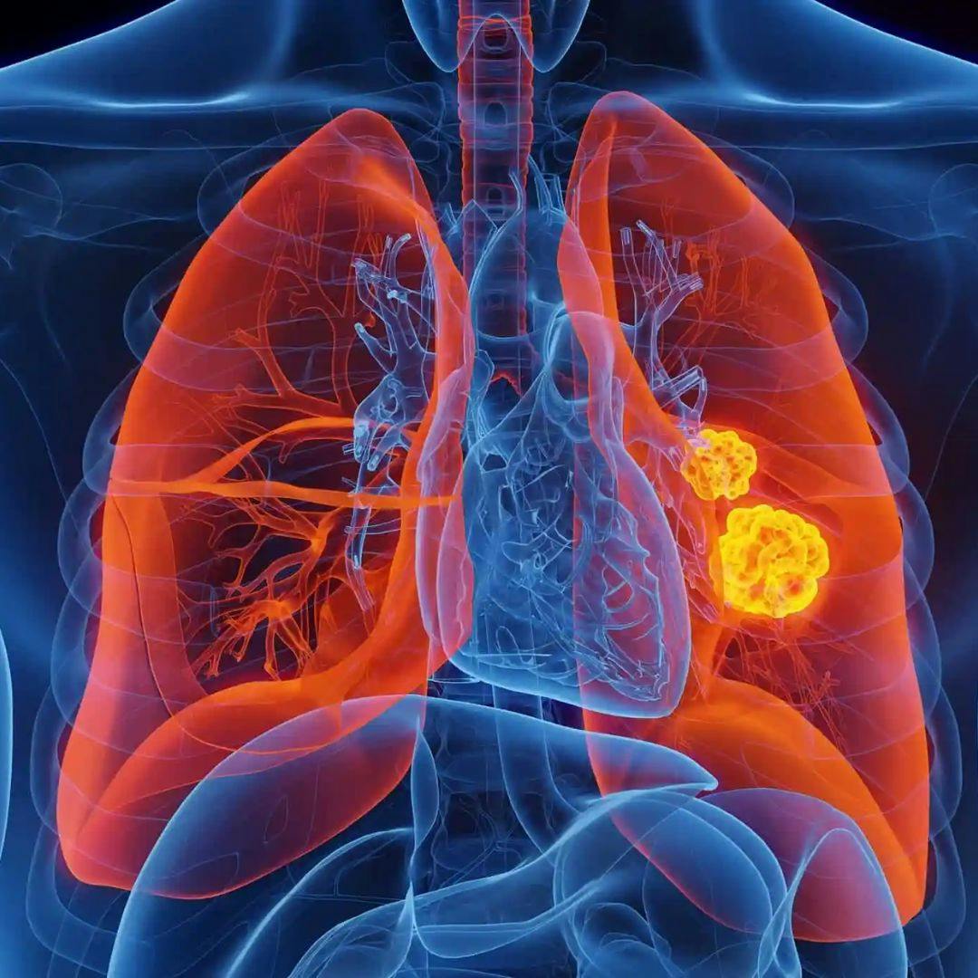 Las posibilidades de curar el cáncer de pulmón