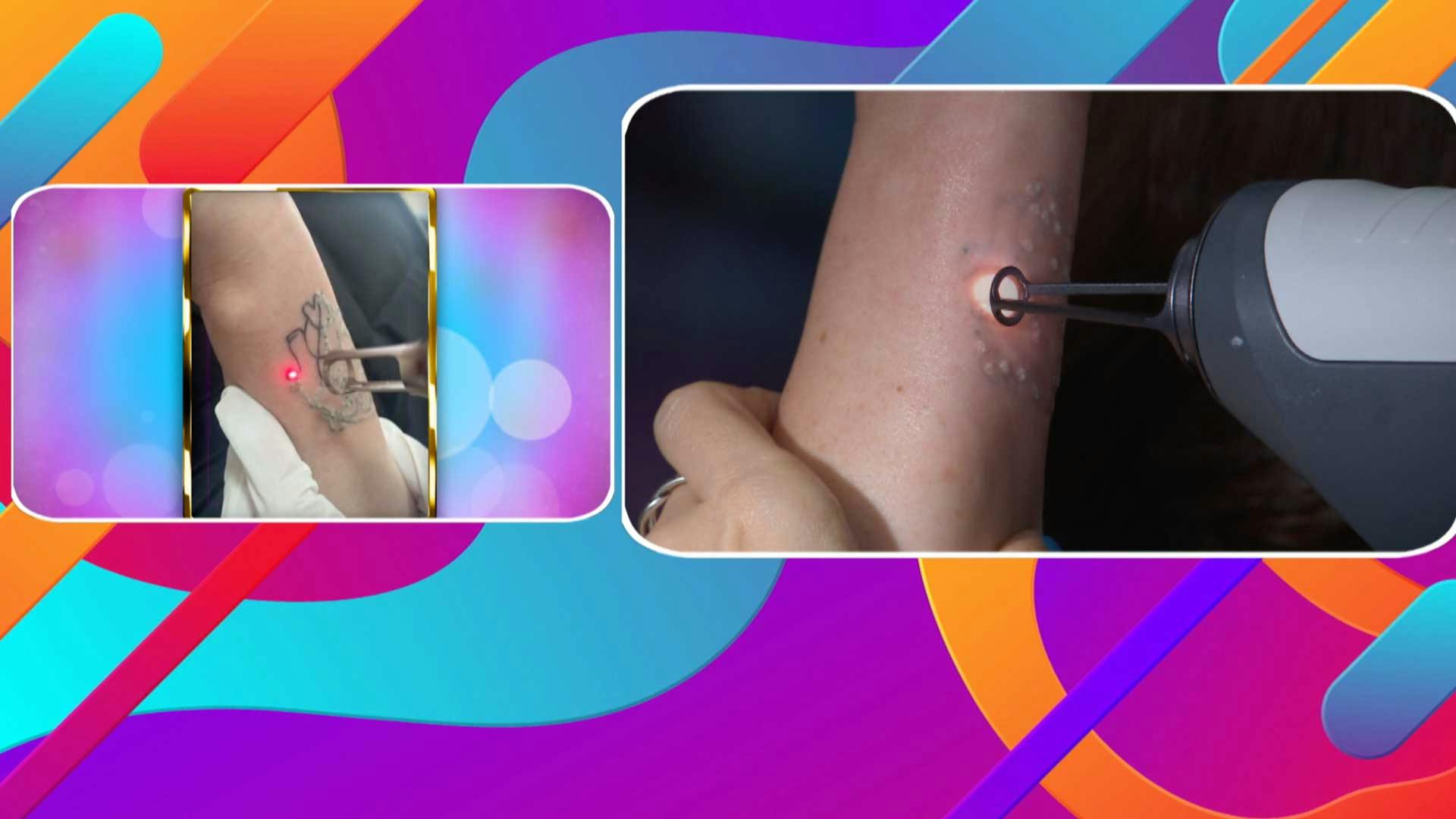 Programa 17 julio 2024 Parte 1 | Te mostramos un método para quitar tatuajes