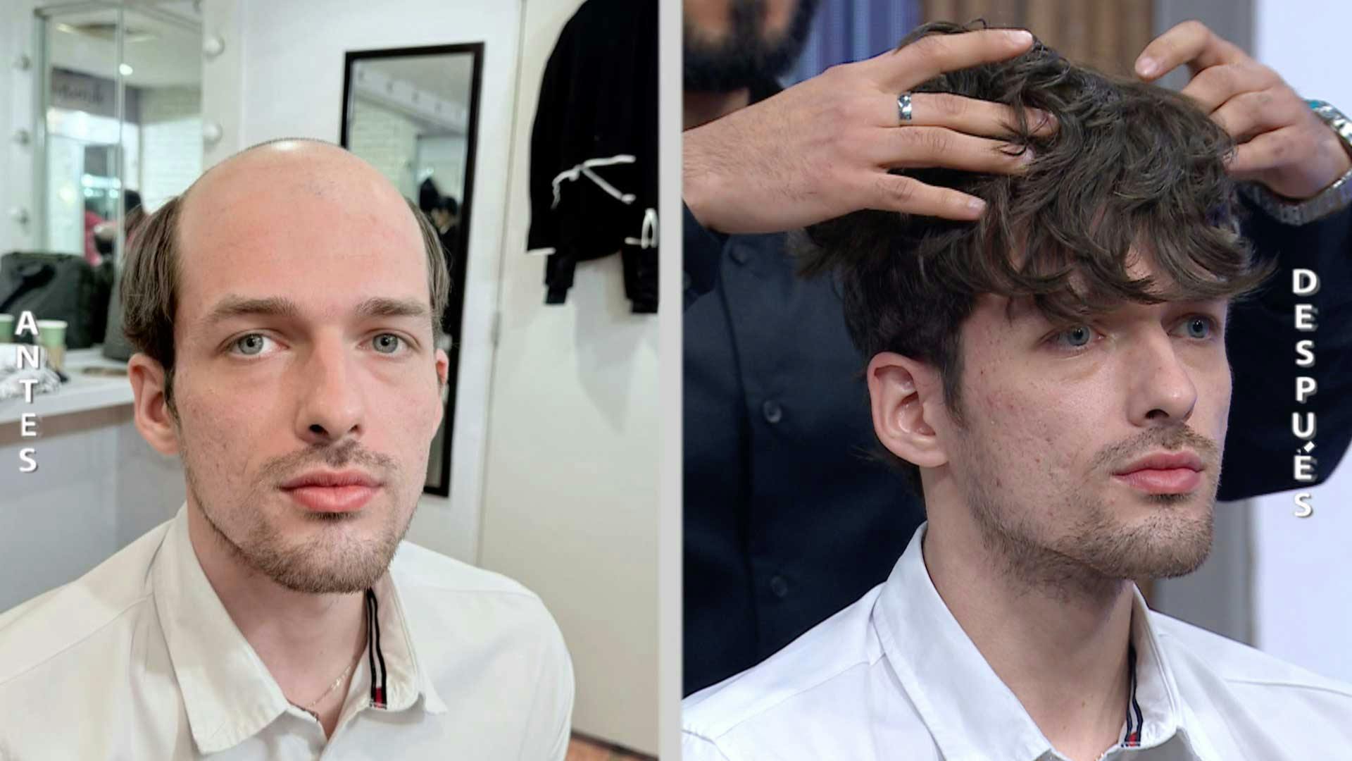 ¡Atención hombres! Recupera el control de tu apariencia con prótesis capilares