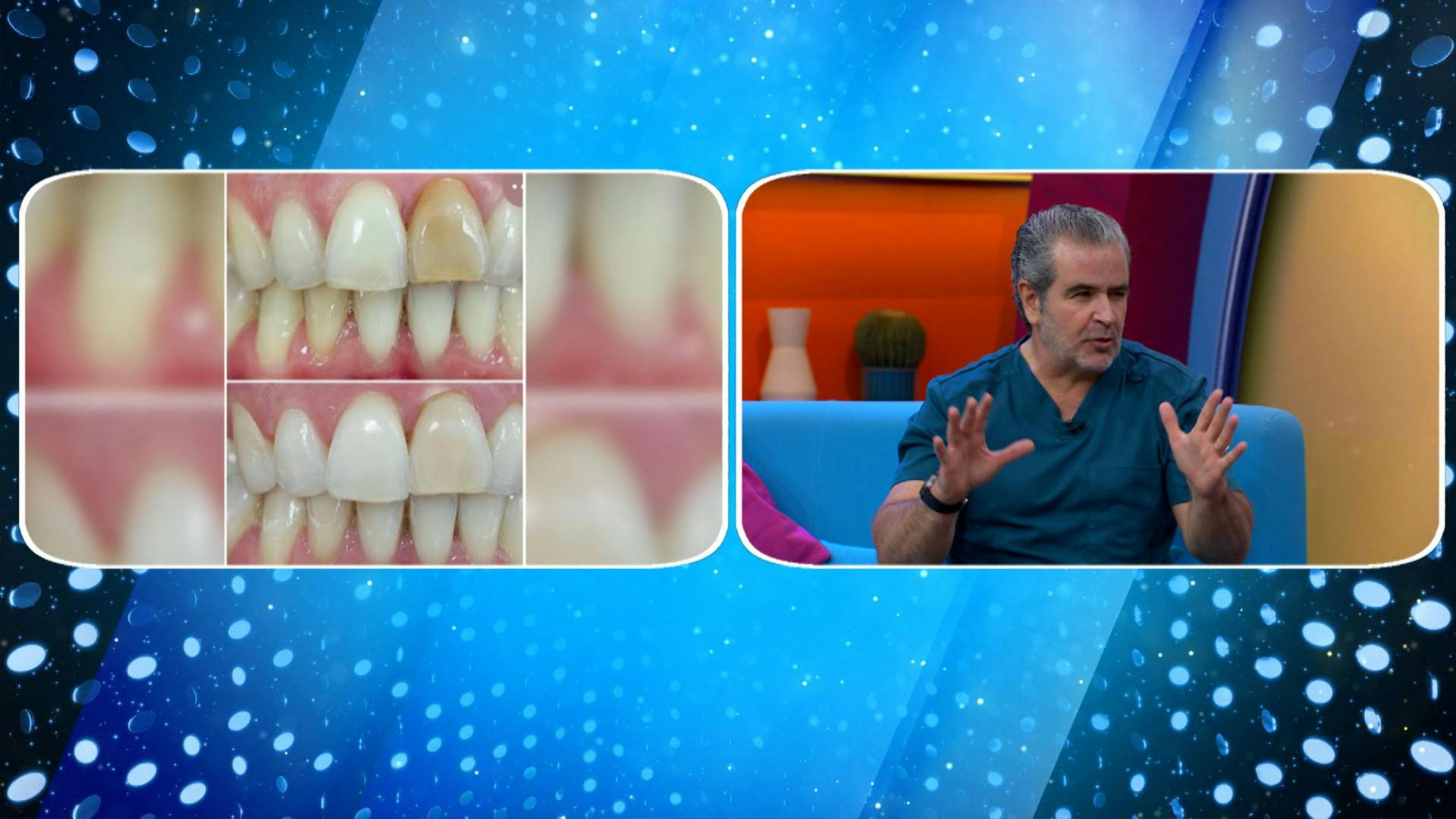 Lo que no te contaron del blanqueamiento dental: técnicas, mitos y verdades, tratamientos caseros, candidatos y más