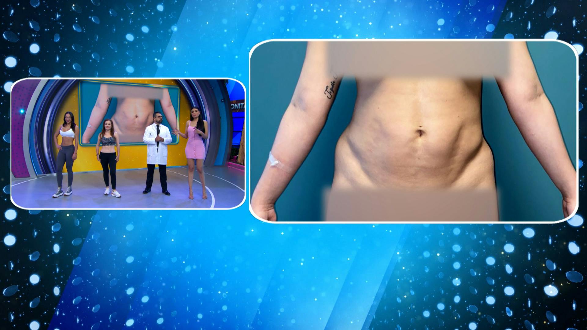 ¿Liposucción o abdominoplastia? ¿Cuál es el tratamiento adecuado para ti? ¡Entérate!
