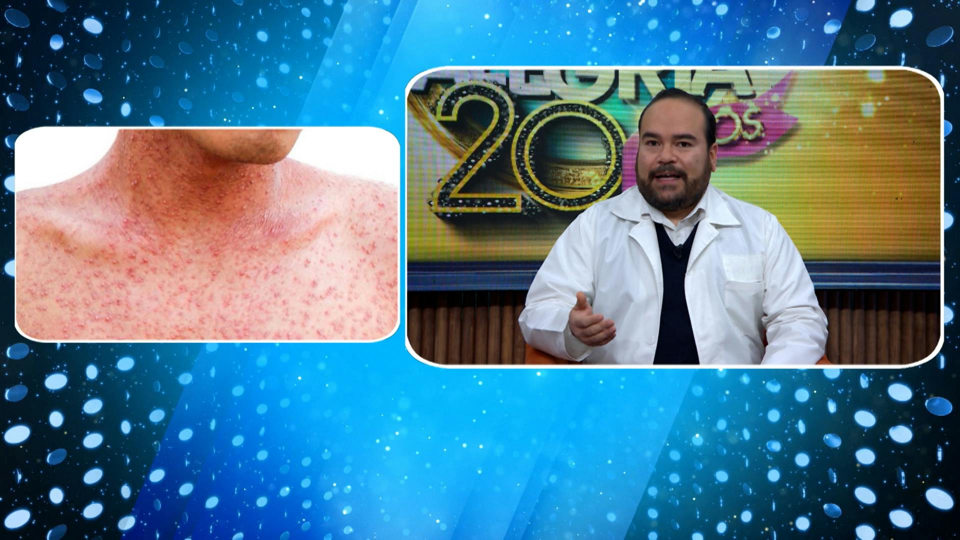 ¿Por qué es tan contagioso el sarampión? El Dr. José Alberto Carranco explicó todo sobre la enfermedad viral