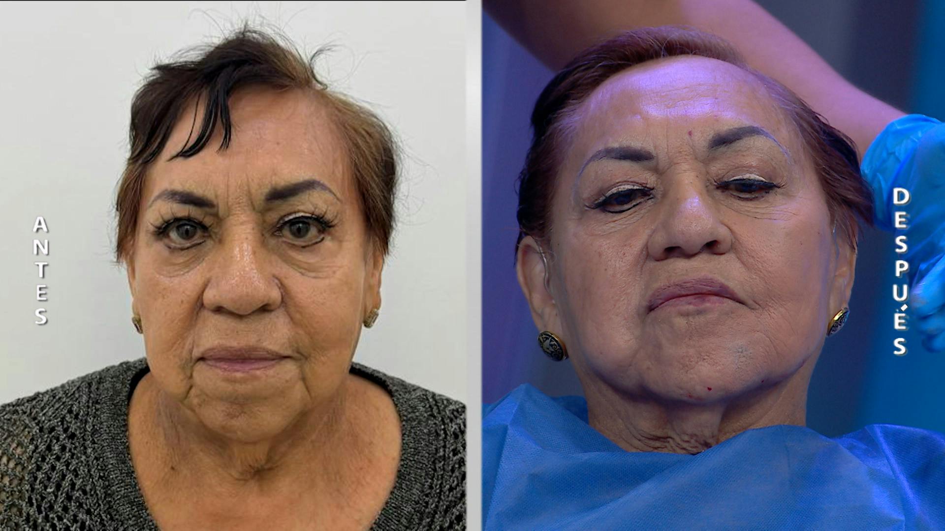 ¡Rejuvenece tu rostro con armonización facial! Lucirás una piel firme y natural