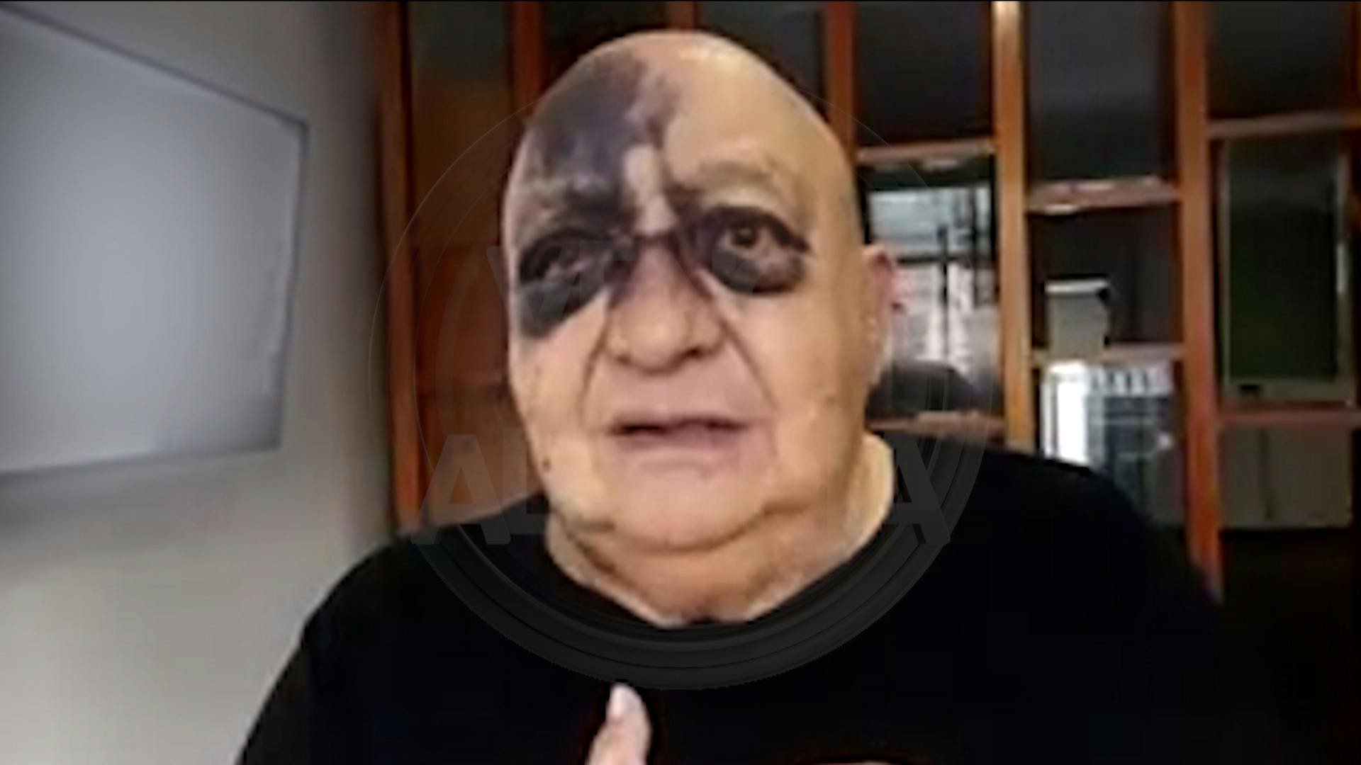 ¡Encendió las alarmas! Luis de Alba sufrió un terrible accidente y habla de su estado de salud