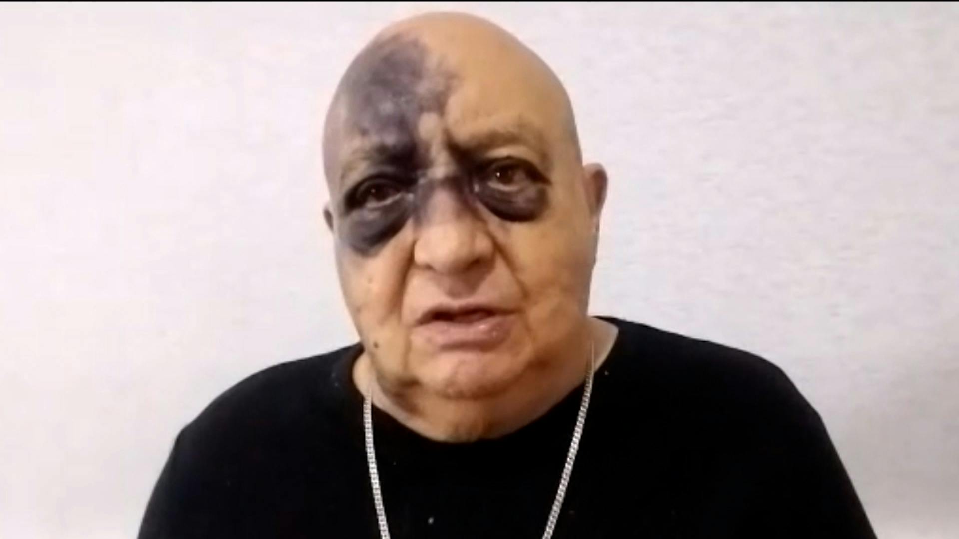 Exclusiva: Luis de Alba relata cómo fue el aparatoso accidente que sufrió y lo dejó con fuertes moretones