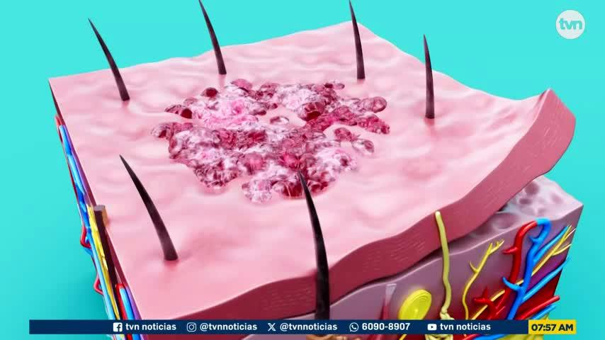 Aló Doctor: Cáncer de Piel