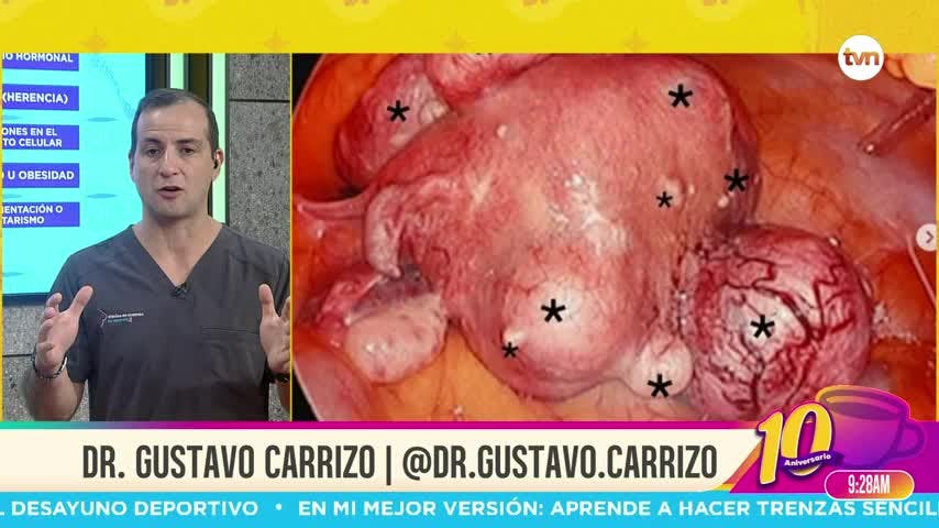 Cita Médica: Los Miomas Uterinos