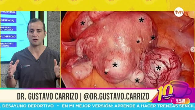 Cita Médica: Los Miomas Uterinos